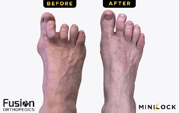 Bunion Surgery Before and After Photos